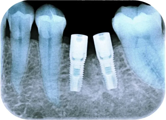 Framed Print : Dental implants following tooth extraction, X-ray Framed Print : Dental implants following tooth extraction, X-ray