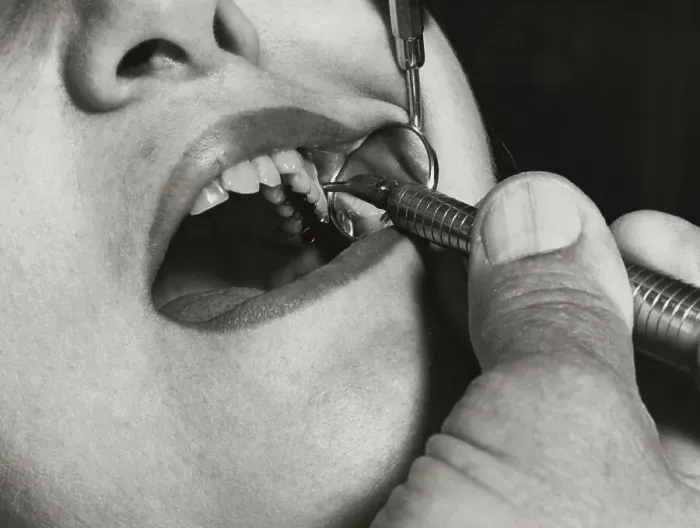 Framed Print : Dentist Drilling Inside a Mouth Framed Print : Dentist Drilling Inside a Mouth