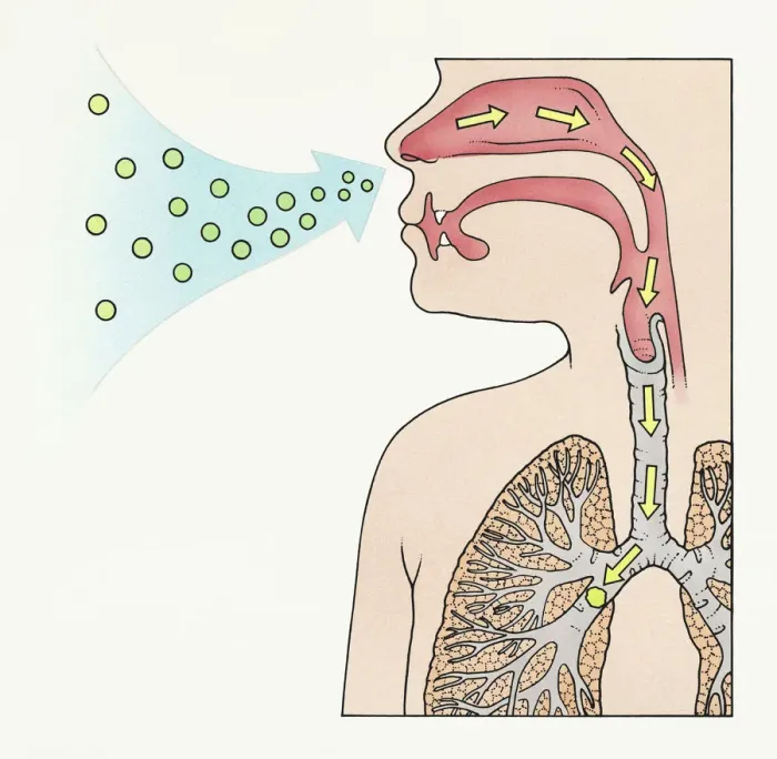 Framed Print : A diagram showing aspergilloma affecting human lung
