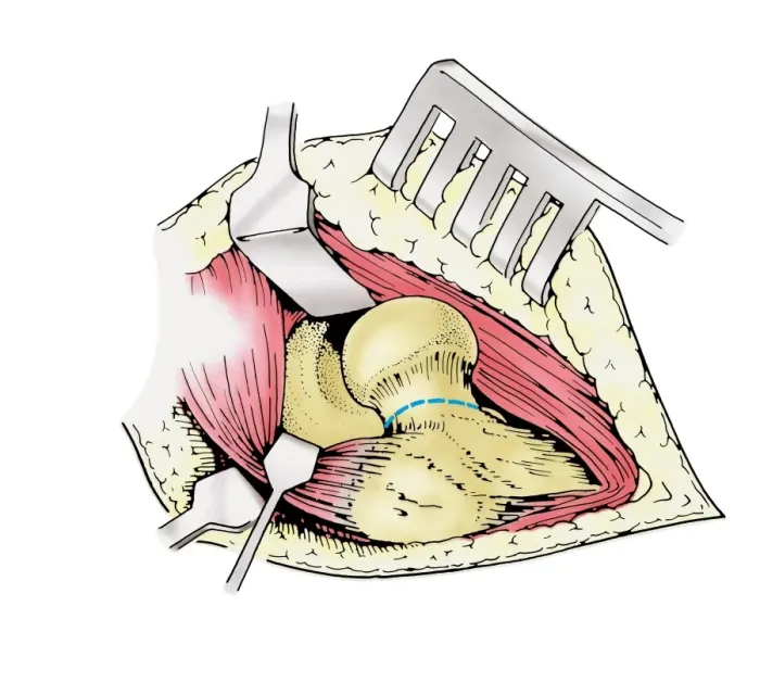 Framed Print : Diagram showing removal of affected head of a femur bone Framed Print : Diagram showing removal of affected head of a femur bone