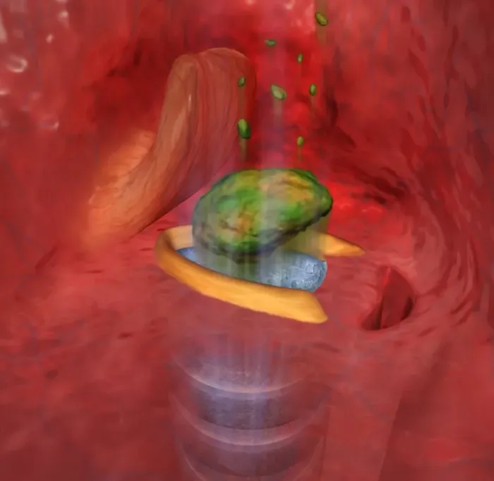 Framed Print : Digital cross section illustration of food entering the trachea the wrong way