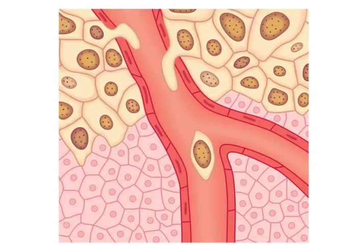 Framed Print : Digital illustration of blood vessel wall rupturing, primary tumour expanding, cells rupturing walls of blood vessels, enabling cancerous cells to detach and spread via blood flow Framed Print : Digital illustration of blood vessel wall rupturing, primary tumour expanding, cells rupturing walls of blood vessels, enabling cancerous cells to detach and spread via blood flow