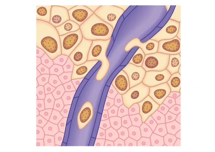 Framed Print : Digital illustration of breached lymph vessel as primary tumour grows and its cells invade adjacent tissues