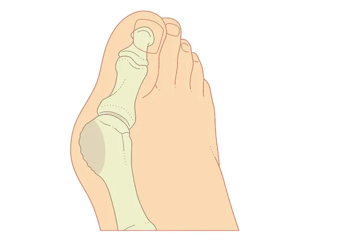 Framed Print : Digital illustration of bunion with enlargement of bone around joint at base of big toe