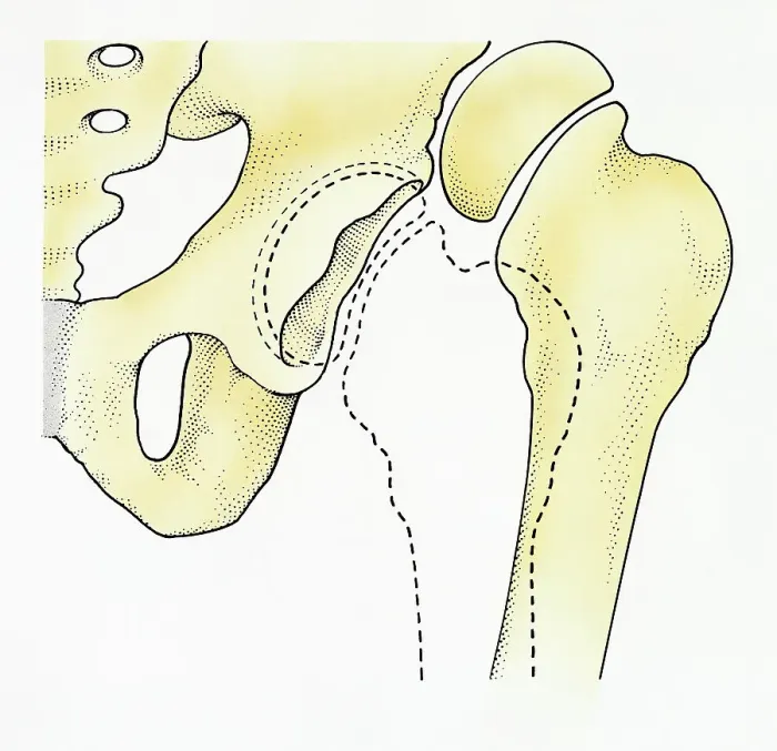 Framed Print : Digital illustration of dislocated hip Framed Print : Digital illustration of dislocated hip