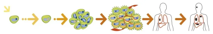 Framed Print : Digital illustration of the evolution of a cancer from initiation to metastasis Framed Print : Digital illustration of the evolution of a cancer from initiation to metastasis