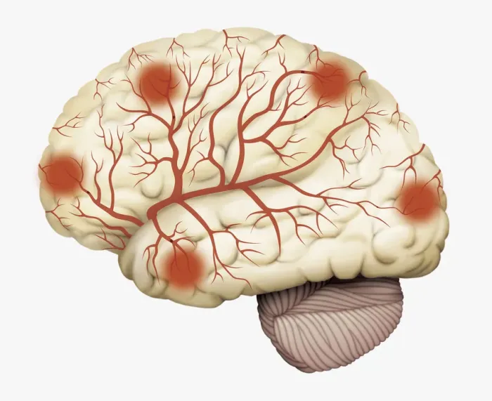 Framed Print : Digital illustration of human brain showing blood vessels, and areas of dead tissue highlighted in red Framed Print : Digital illustration of human brain showing blood vessels, and areas of dead tissue highlighted in red