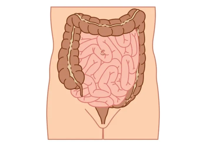 Framed Print : Digital illustration of location of intussusception in small intestine Framed Print : Digital illustration of location of intussusception in small intestine