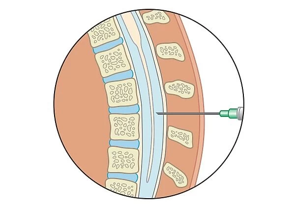 Digital illustration of lumbar puncture using spinal needle inserted into lumbar vertebrae and dura mater