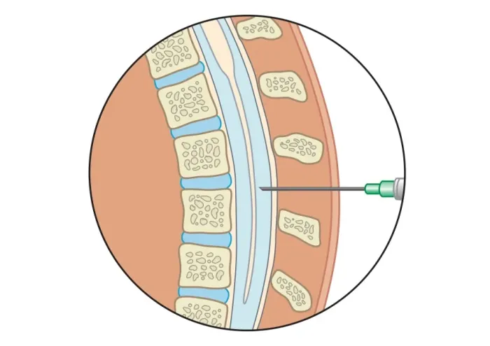 Framed Print : Digital illustration of lumbar puncture using spinal needle inserted into lumbar vertebrae and dura mater