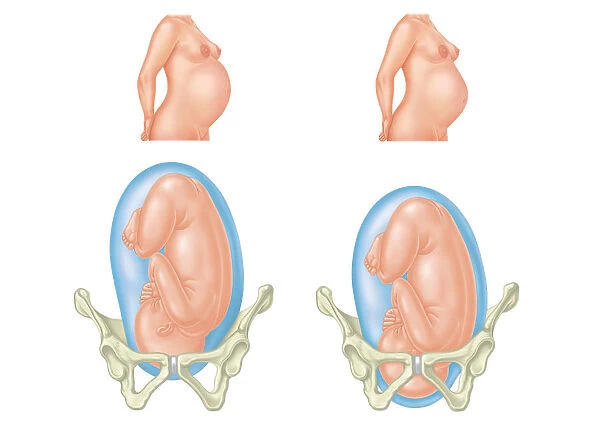 Digital illustration of pregnant two women and position of each babys head entering and inside pelvic area