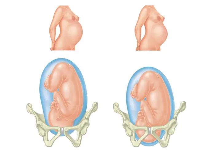 Framed Print : Digital illustration of pregnant two women and position of each babys head entering and inside pelvic area