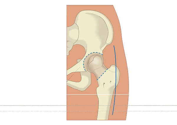 Digital illustration of prosthetic hip joint replacement
