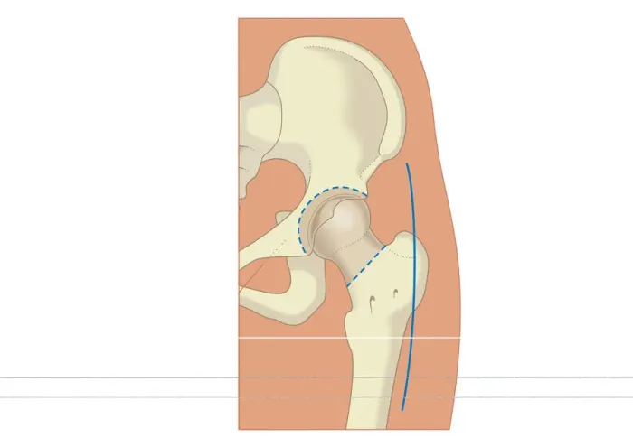 Framed Print : Digital illustration of prosthetic hip joint replacement Framed Print : Digital illustration of prosthetic hip joint replacement