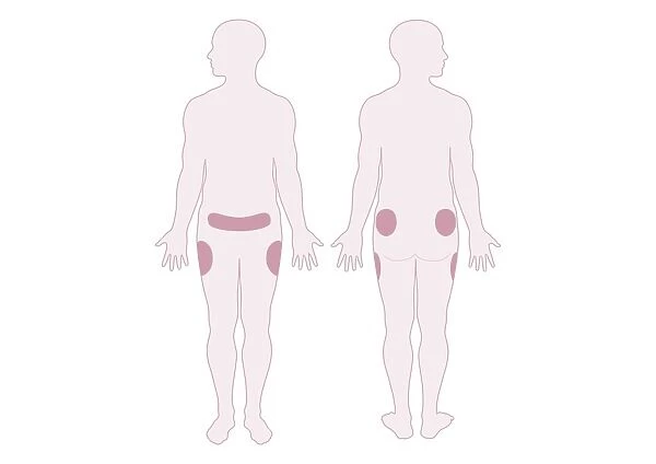 Digital illustration representing areas of fat distribution on belly, hips and thighs