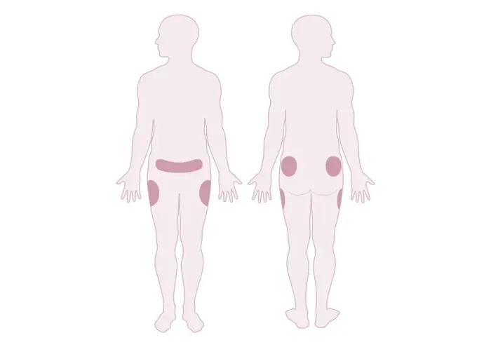 Framed Print : Digital illustration representing areas of fat distribution on belly, hips and thighs Framed Print : Digital illustration representing areas of fat distribution on belly, hips and thighs