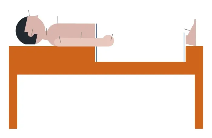 Framed Print : Digital illustration representing man lying on back on acupuncture table Framed Print : Digital illustration representing man lying on back on acupuncture table