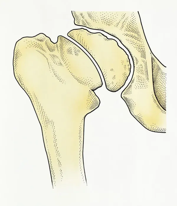 Framed Print : Digital illustration showing degeneration of hip joint known as Perthes disease Framed Print : Digital illustration showing degeneration of hip joint known as Perthes disease