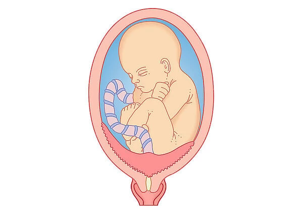 Digital illustration showing placenta praevia where the placenta is attached to the uterine wall, entirely covering the cervix
