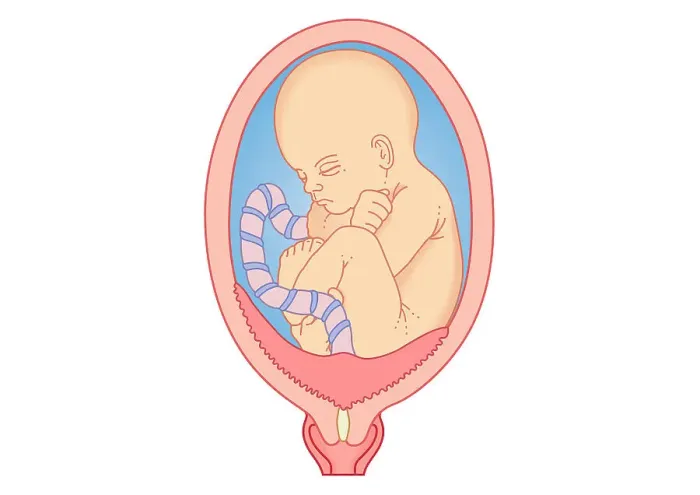 Framed Print : Digital illustration showing placenta praevia where the placenta is attached to the uterine wall, entirely covering the cervix Framed Print : Digital illustration showing placenta praevia where the placenta is attached to the uterine wall, entirely covering the cervix