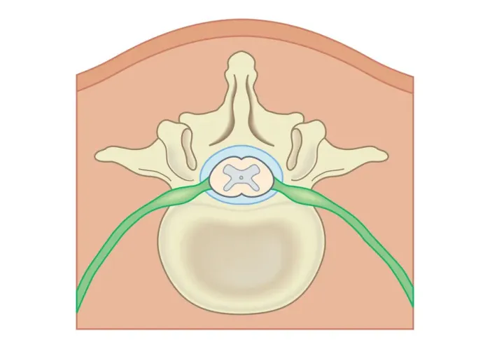 Framed Print : Digital illustration Spina Bifida, Meningocele, where protective covering around spinal cord protrudes through malformed vertebra to form sac filled with cerebrospinal fluid Framed Print : Digital illustration Spina Bifida, Meningocele, where protective covering around spinal cord protrudes through malformed vertebra to form sac filled with cerebrospinal fluid