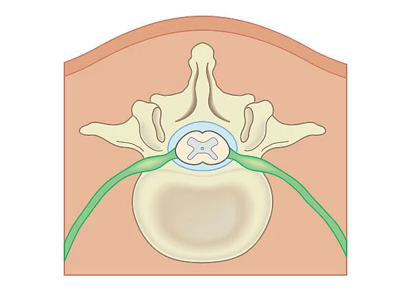 Digital illustration Spina Bifida, Meningocele, where protective covering around spinal cord protrudes through malformed vertebra to form sac filled with cerebrospinal fluid