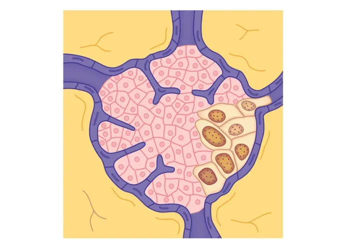 Framed Print : Digital illustration of tumour in lymph node Framed Print : Digital illustration of tumour in lymph node