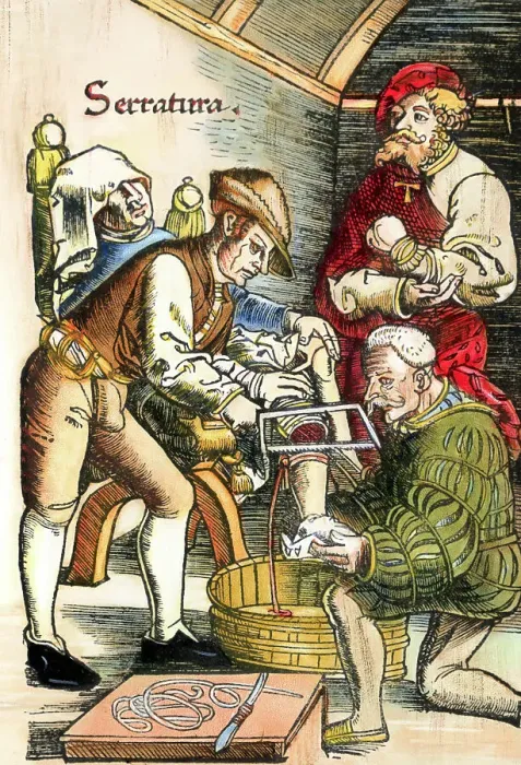 Framed Print : Drawing of an Early History Leg Amputation Framed Print : Drawing of an Early History Leg Amputation