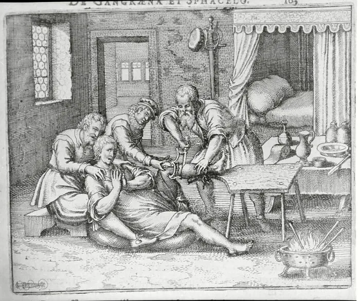 Framed Print : Drawing Showing Surgical Team During Amputation