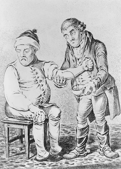 Framed Print : Early Physician Bloodletting a Patient Framed Print : Early Physician Bloodletting a Patient