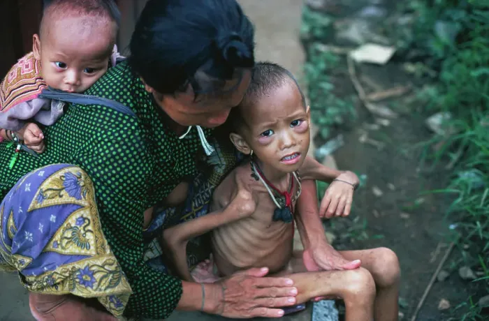 Framed Print : Emaciated Child with Relief Services Aide Framed Print : Emaciated Child with Relief Services Aide