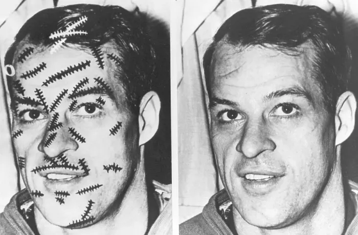 Framed Print : Gordie Howe with Stitches on Face Framed Print : Gordie Howe with Stitches on Face