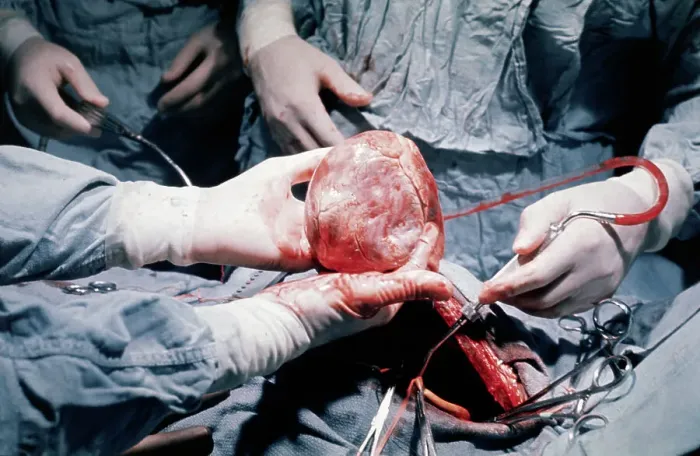 Framed Print : Heart Transplant Operation Framed Print : Heart Transplant Operation