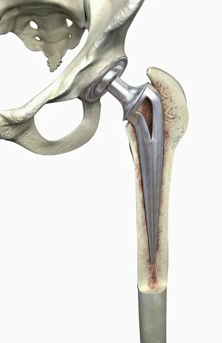 Framed Print : Hip replacement Framed Print : Hip replacement