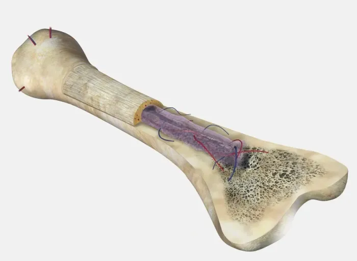 Framed Print : Human bone, cross section diagram of Femur showing osteon, veins, marrow Framed Print : Human bone, cross section diagram of Femur showing osteon, veins, marrow