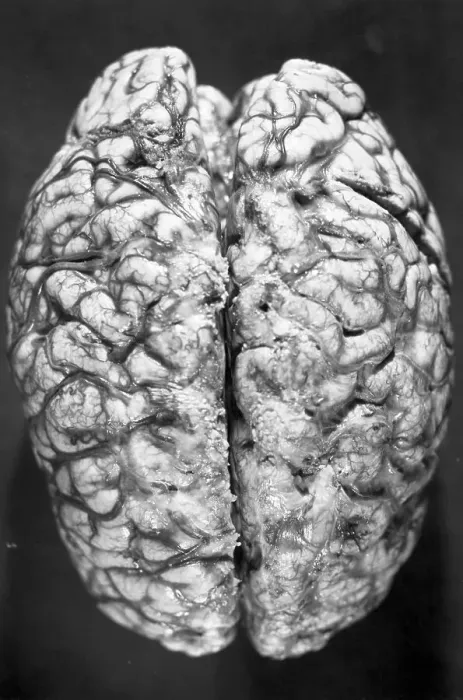 Framed Print : Top of Human Brain Framed Print : Top of Human Brain