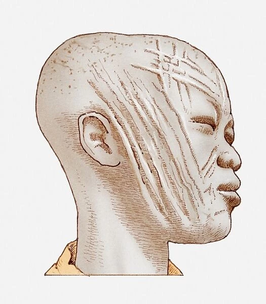 Illustration of African womans head showing scarring