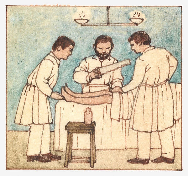 Illustration of ancient surgery techniques, using saw to amputate