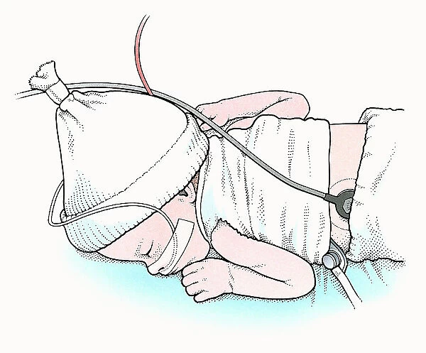 Illustration of baby lying on front in incubator