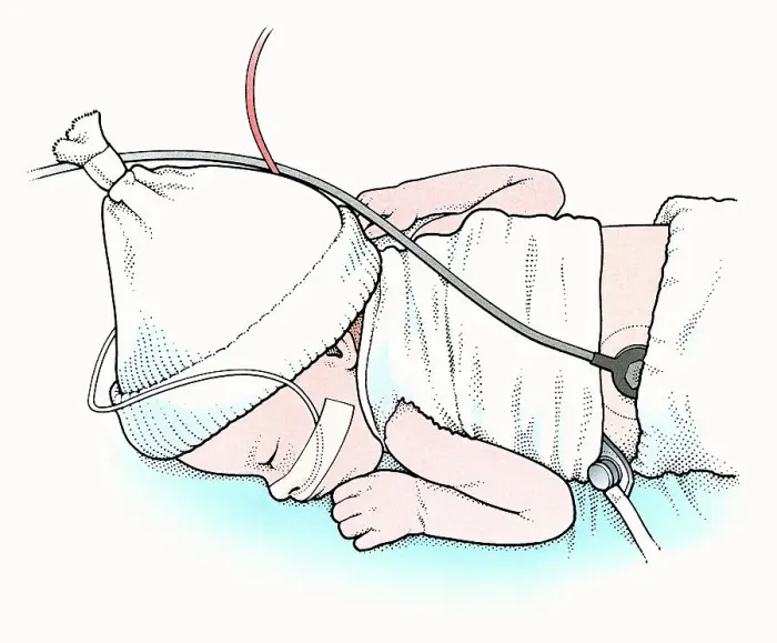 Framed Print : Illustration of baby lying on front in incubator Framed Print : Illustration of baby lying on front in incubator