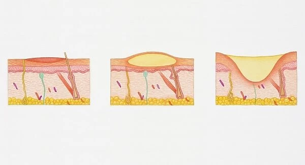 Illustration of blistering second degree burn in epidermis and dermis in three cross sections of human skin