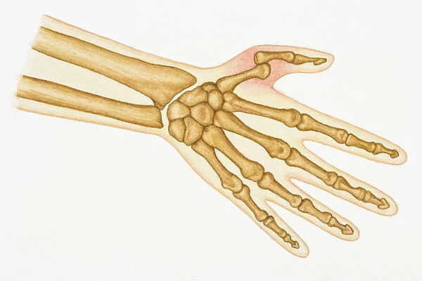 Illustration of bones in human hand and dislocated thumb