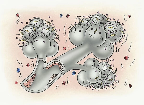 Illustration of bronchus and alveolus covered in inorganic particles, fibroblasts, and growth factor obstructing the internal lining