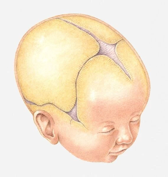 Illustration of Coronal Suture on head of newborn baby