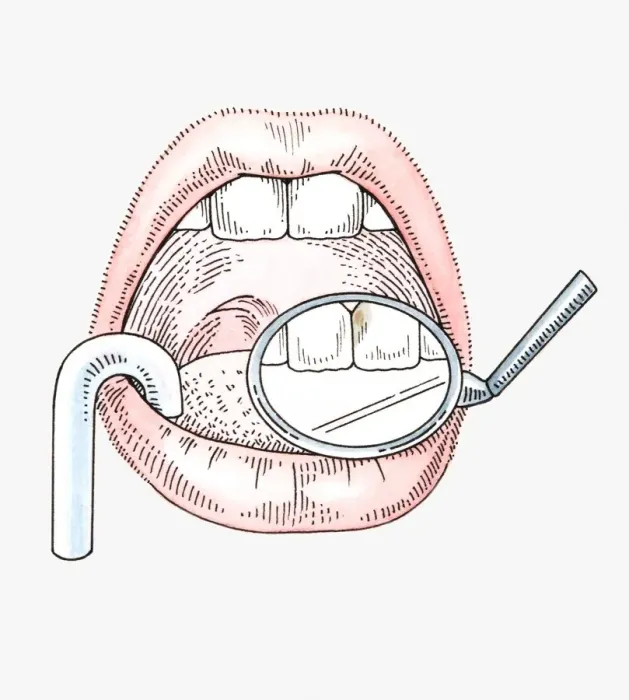 Framed Print : Illustration of dental examination using mirror and suction tube Framed Print : Illustration of dental examination using mirror and suction tube