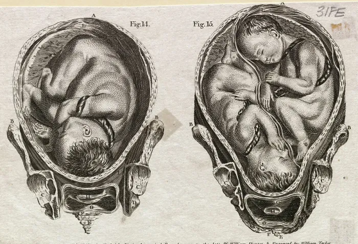 Framed Print : Illustration Depicting Fetuses in the Womb Framed Print : Illustration Depicting Fetuses in the Womb
