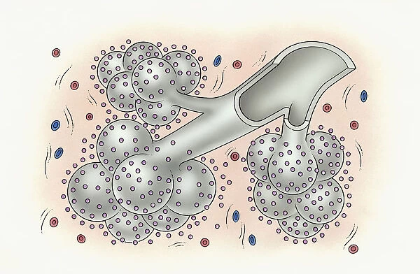Illustration of development of idiopathic pulmonary fibrosis showing bronchus and alveolus covered in small inorganic particles