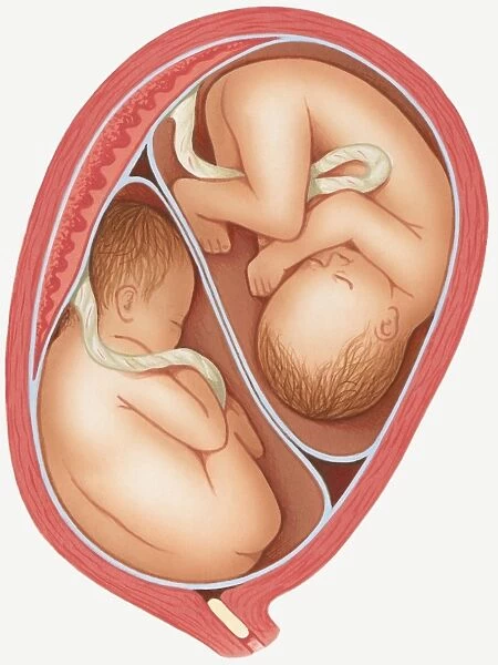 Illustration of dizygotic twins in uterus, and mucus plug in cervix