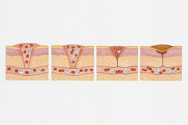 Illustration of formation of blood clot in series of four cross section illustrations showing blood oozing from blood vessel through wound before forming platelet plug