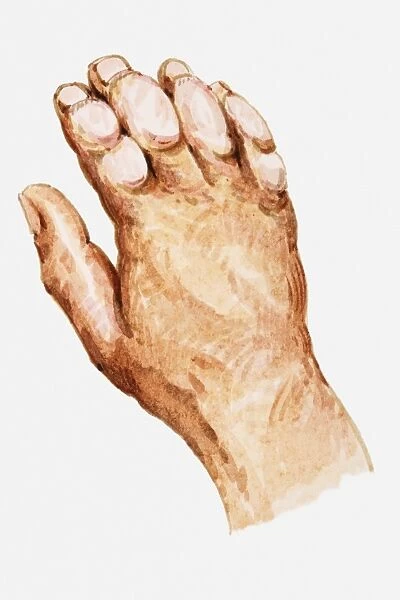 Illustration of hand showing frostbite